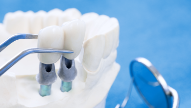 افضل انواع زراعة الاسنان في الكويت واسعارها