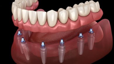 افضل دكتور زراعة اسنان في الكويت