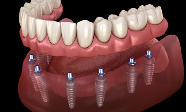 افضل دكتور زراعة اسنان في الكويت