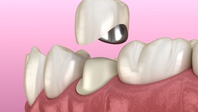 زراعة الأسنان بدون جراحة في الكويت 2023 التكلفة والعيادات